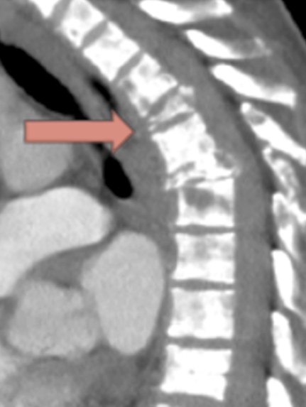 The same T4 vertebra two months later, now fractured