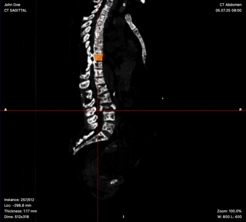 Sagittal CT of the spine in the PathFRAX viewer with one thoracic vertebra highlighted orange